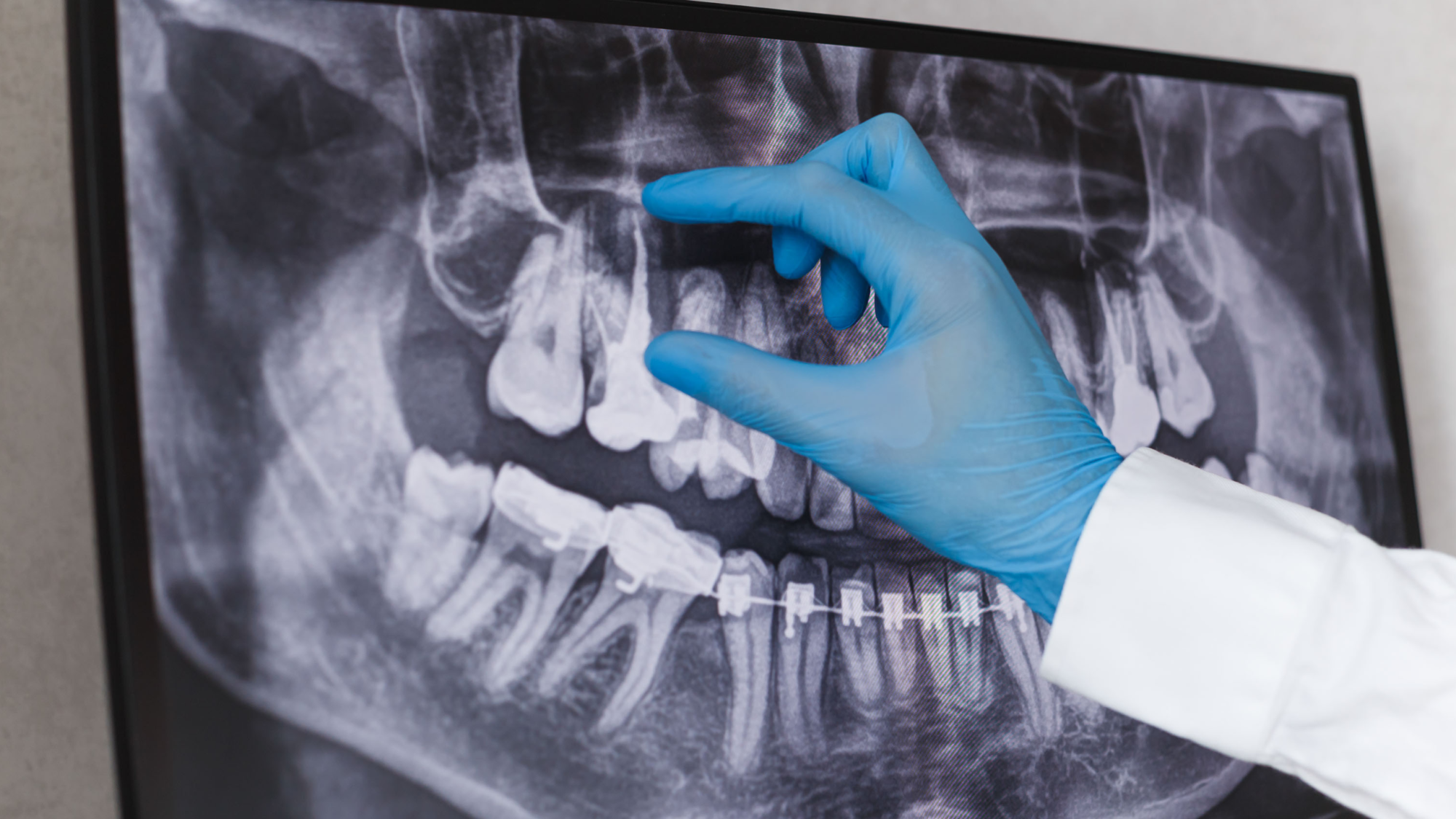 Dental Xray Cumberland Valley Endodontics